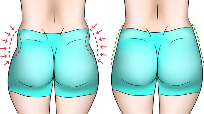 Ini Dia Cara Menghilangkan Hip Dips Secara Alami dan Sehat