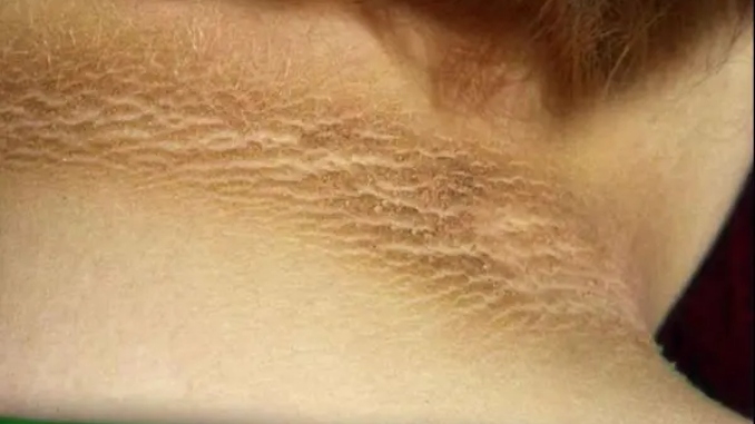 Simak Ini 8 Tanda Gula Darah Tinggi Agar Tubuh Tetap Sehat